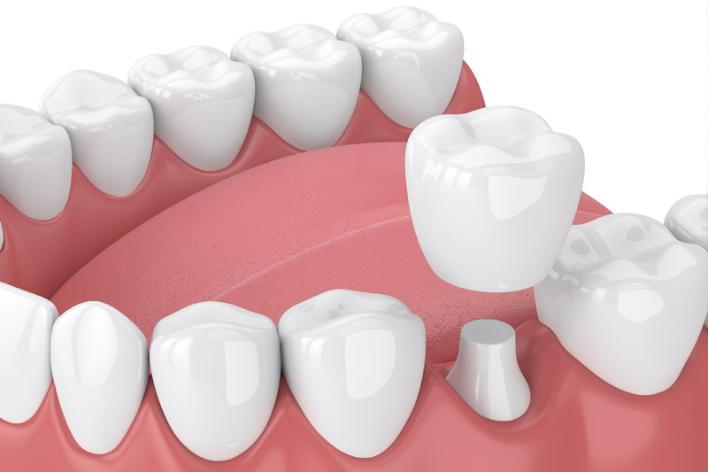 Dental Crowns in Fresno