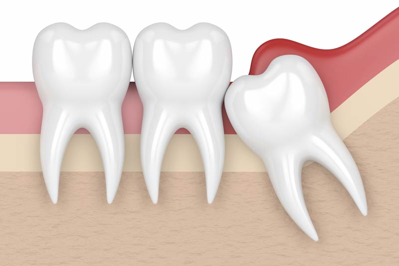 Wisdom Tooth Removal in Fresno